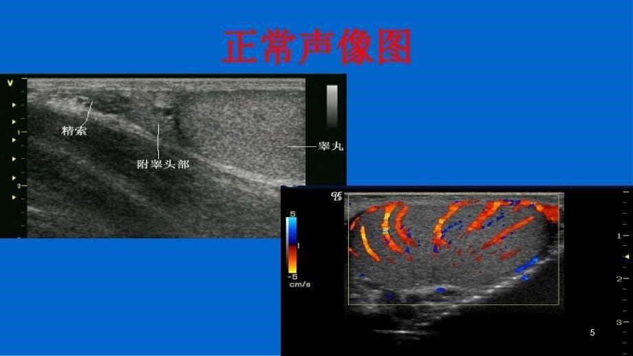 阴囊疾病超声诊断ppt课件_第5页