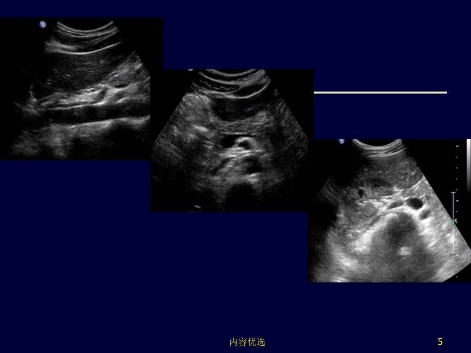 腹膜后间隙超声严选内容_第5页