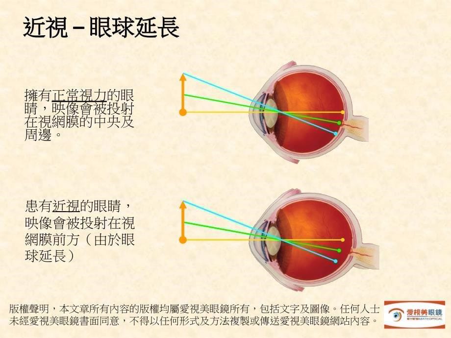 近视–眼球延长课件_第5页