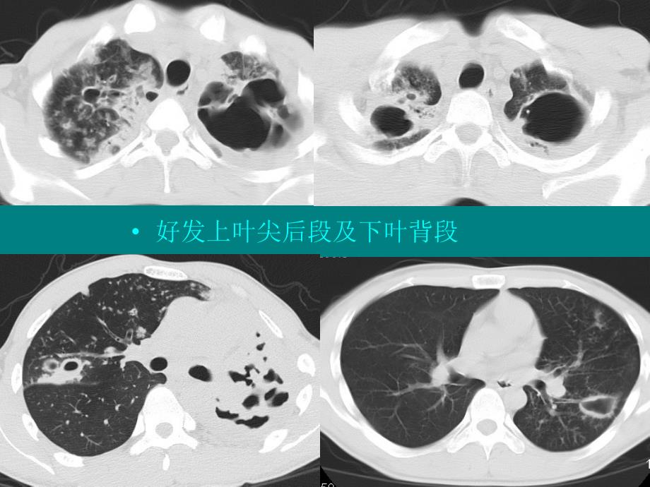 肺部单发空洞病灶的影像诊断_第3页