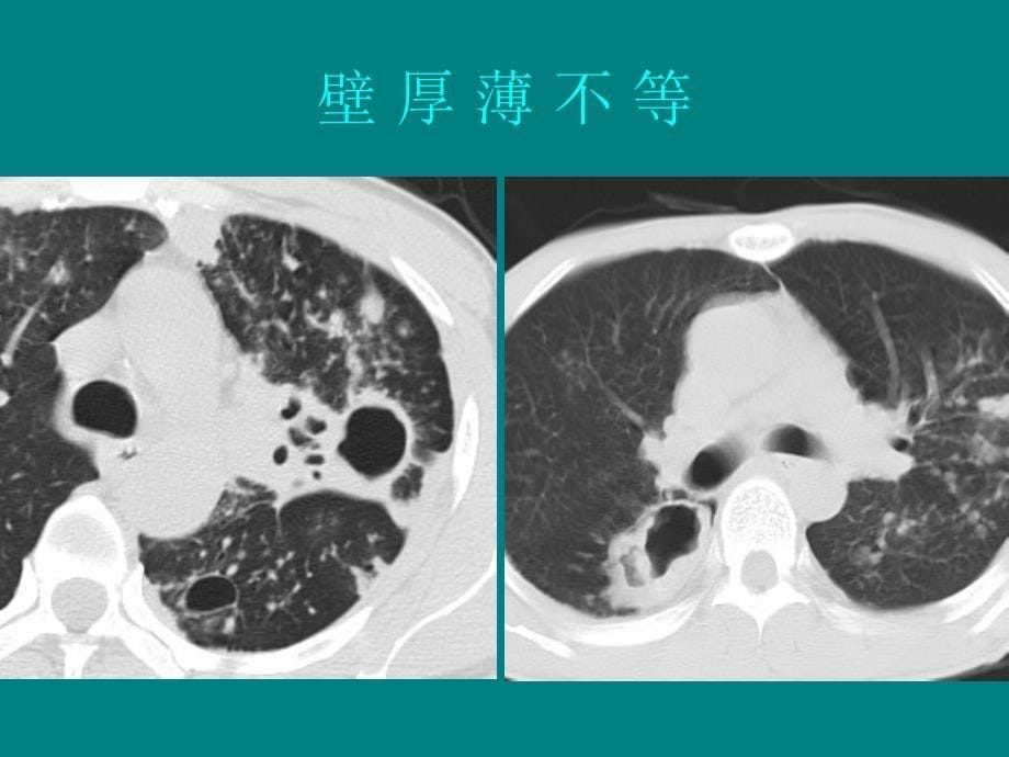 肺部单发空洞病灶的影像诊断_第5页