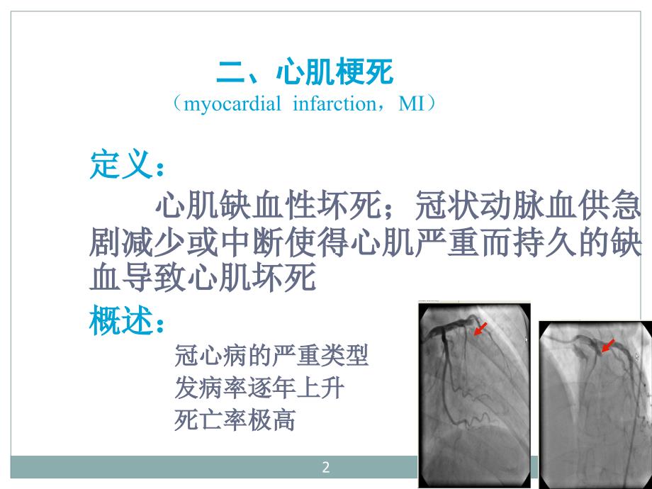 心肌梗死精ppt课件_第2页