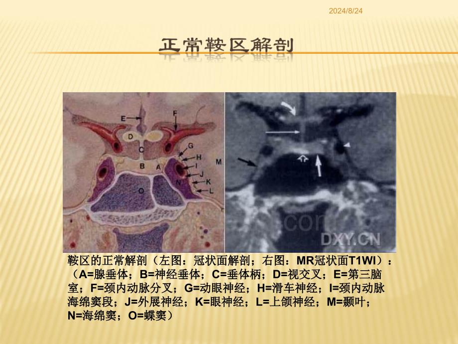 鞍区病变的鉴别诊断-和术_第2页