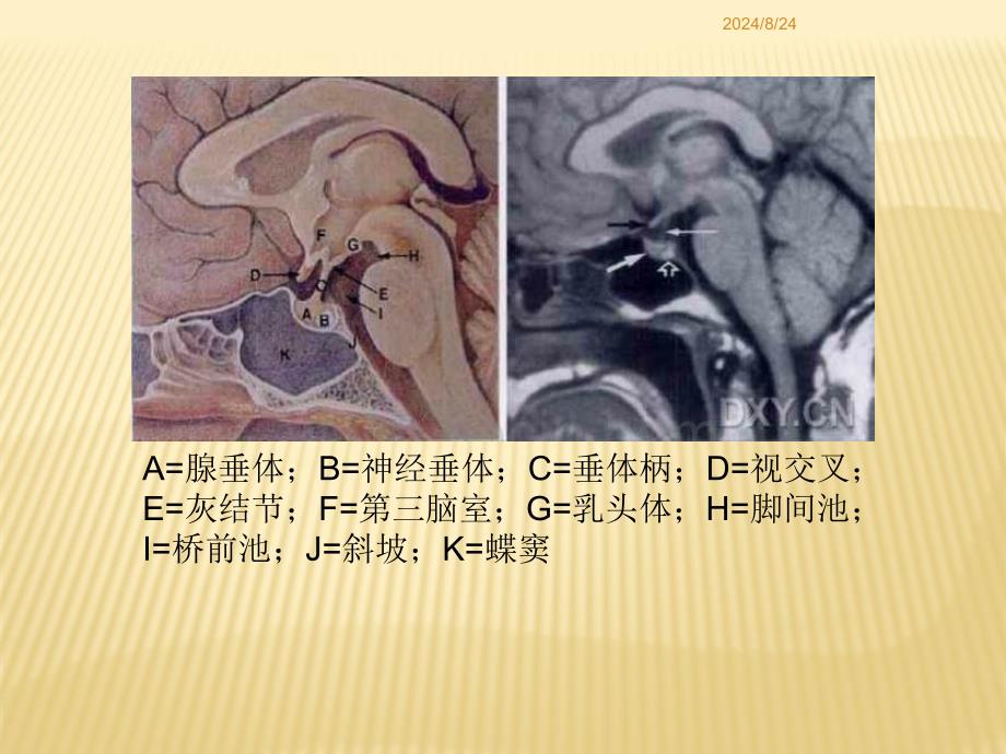 鞍区病变的鉴别诊断-和术_第3页