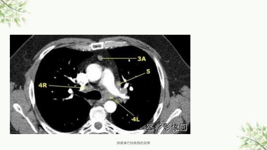 肺癌淋巴结转移的规律课件_第5页