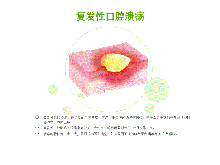 复发性口腔溃疡的中西医治疗ppt课件_第3页