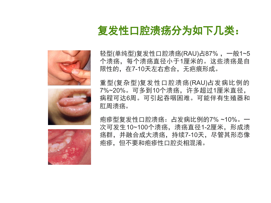 复发性口腔溃疡的中西医治疗ppt课件_第4页