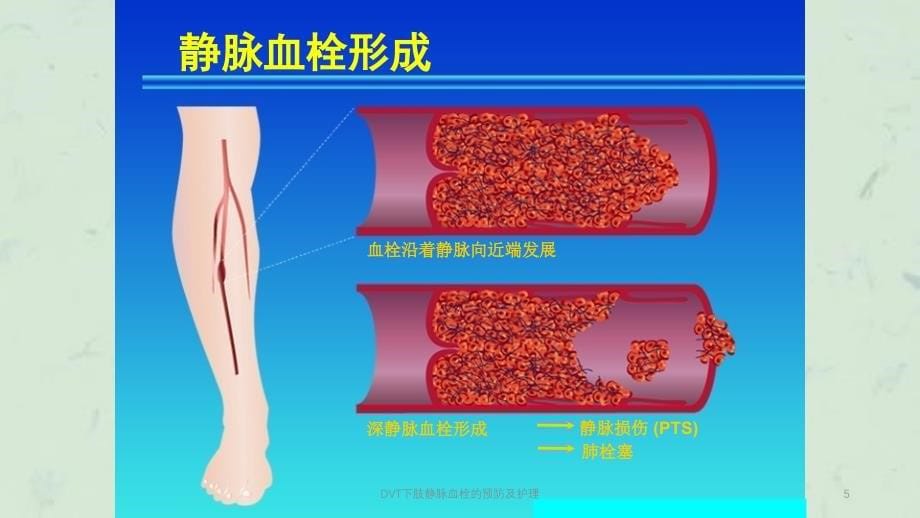 DVT下肢静脉血栓的预防及护理课件_第5页