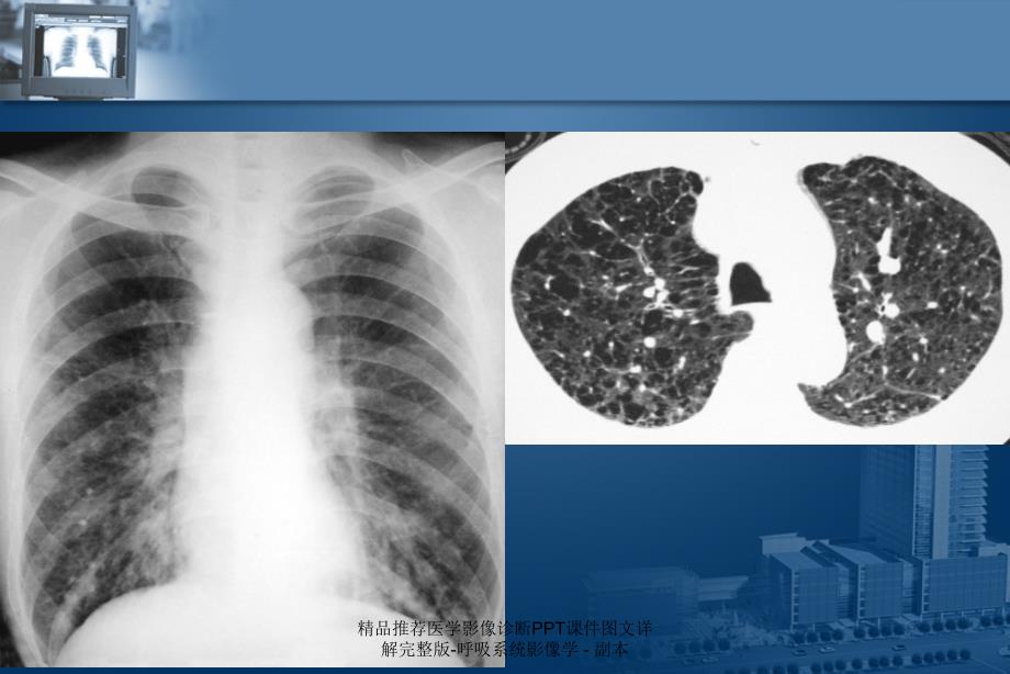 最新精品推荐医学影像诊断PPT课件图文详解完整版呼吸系统影像学副本PPT_第3页