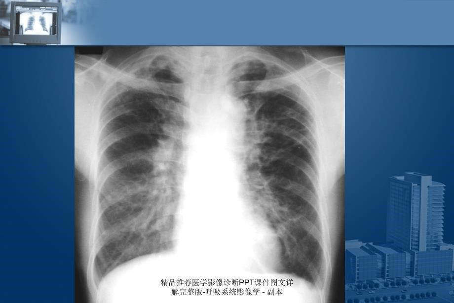 最新精品推荐医学影像诊断PPT课件图文详解完整版呼吸系统影像学副本PPT_第5页