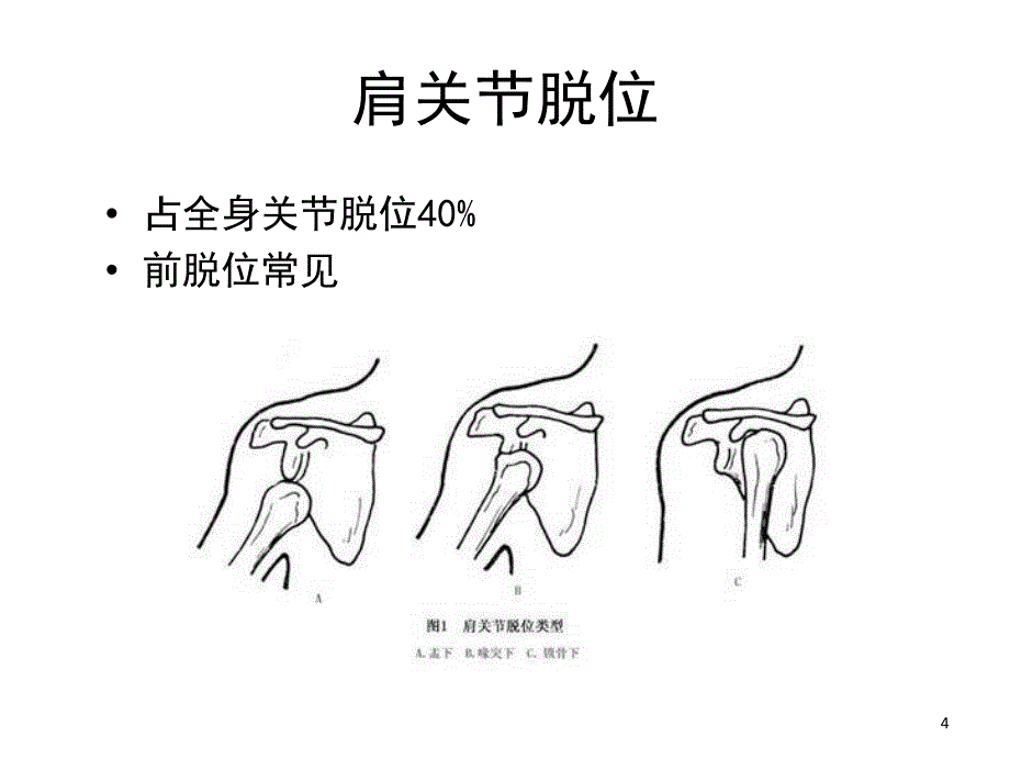 外科学关节脱位课堂PPT_第4页