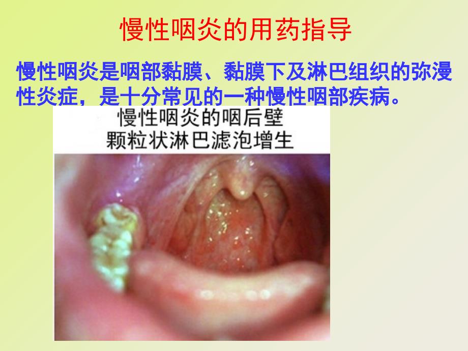 慢性咽炎的用药指导_第1页