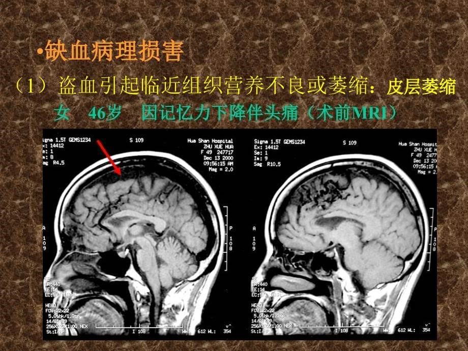 盗血对中枢神经系统影响的临床研究_第5页