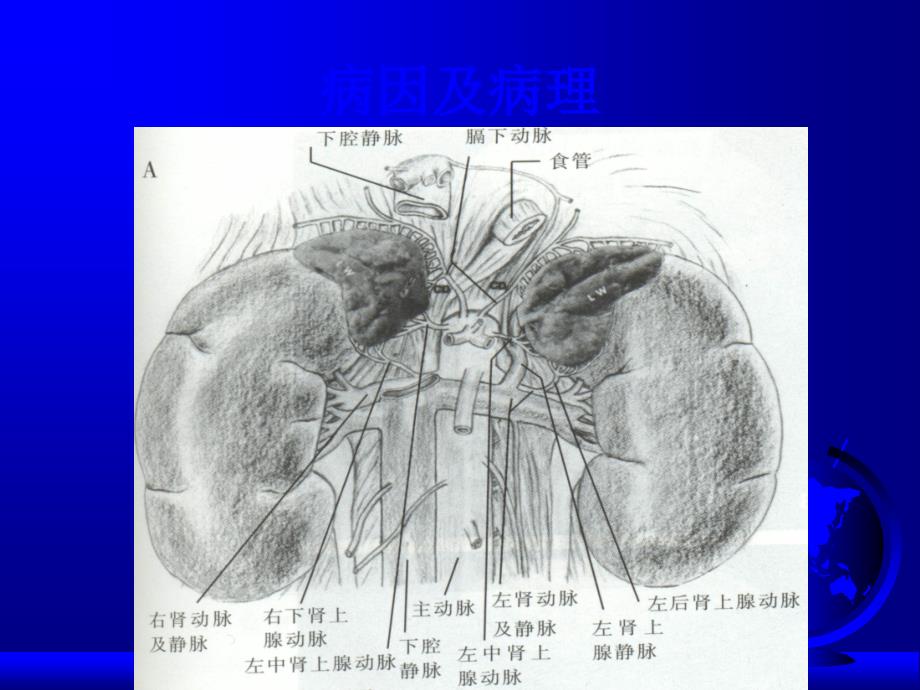 左肾静脉受压综合征ppt课件_第3页