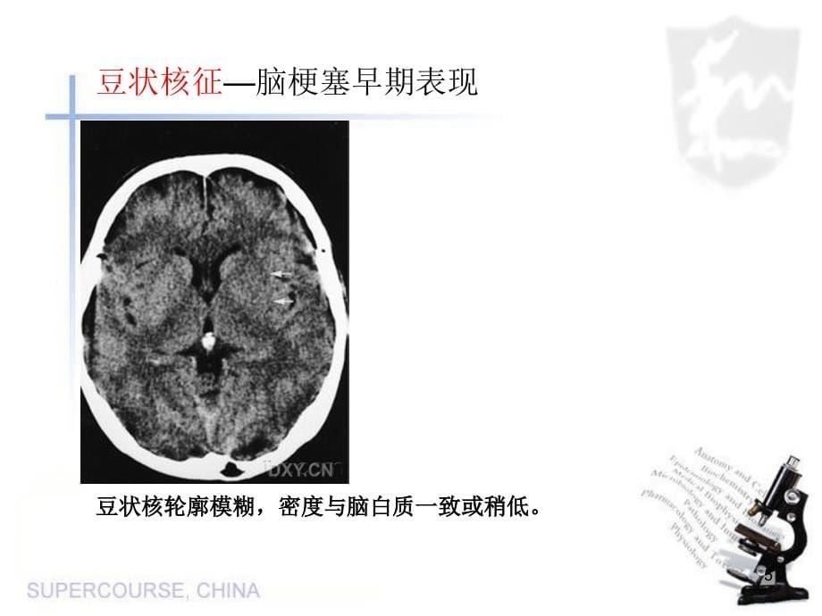 神经科特征性脑影像荟萃_第5页