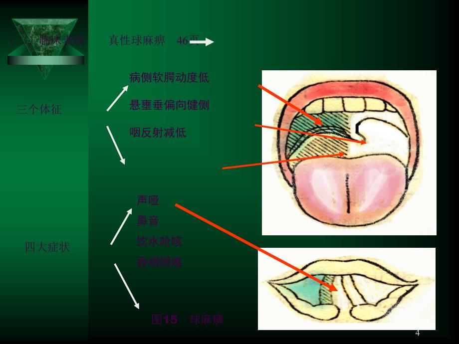 005延髓麻痹ppt课件_第4页