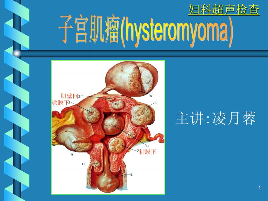 超声诊断学-妇科-子宫肌瘤.ppt_第1页