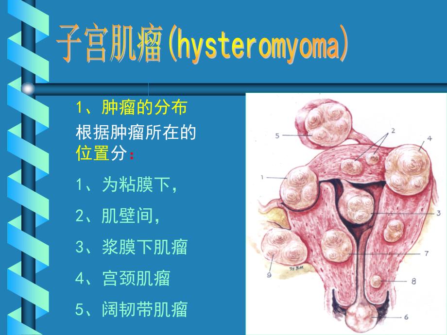 超声诊断学-妇科-子宫肌瘤.ppt_第3页