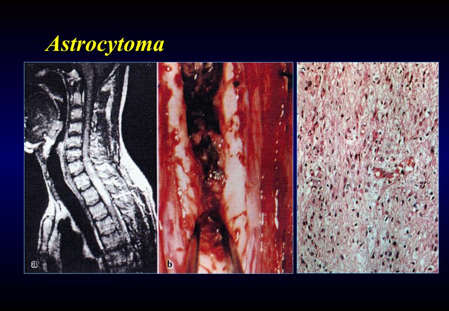 椎管内肿瘤-神经外科教学课件_第2页
