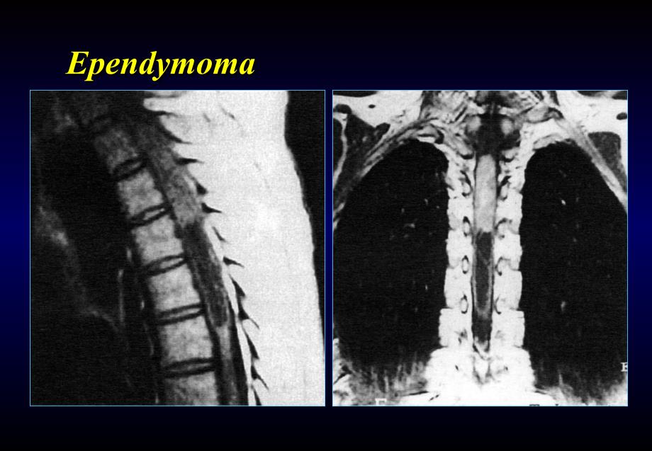 椎管内肿瘤-神经外科教学课件_第4页