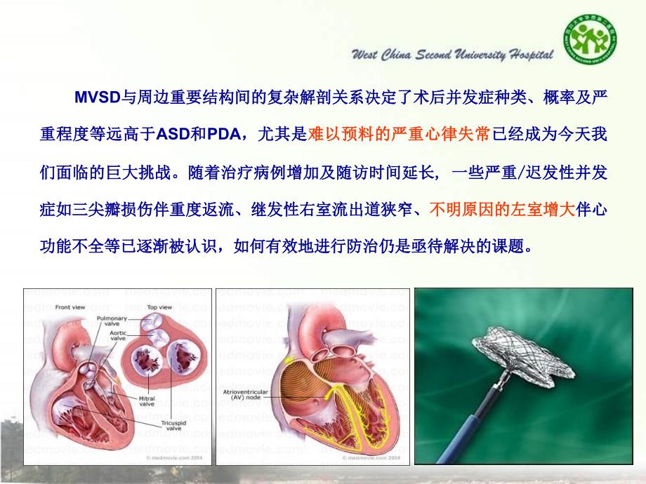 儿童室间隔缺损介入治疗的挑_第2页