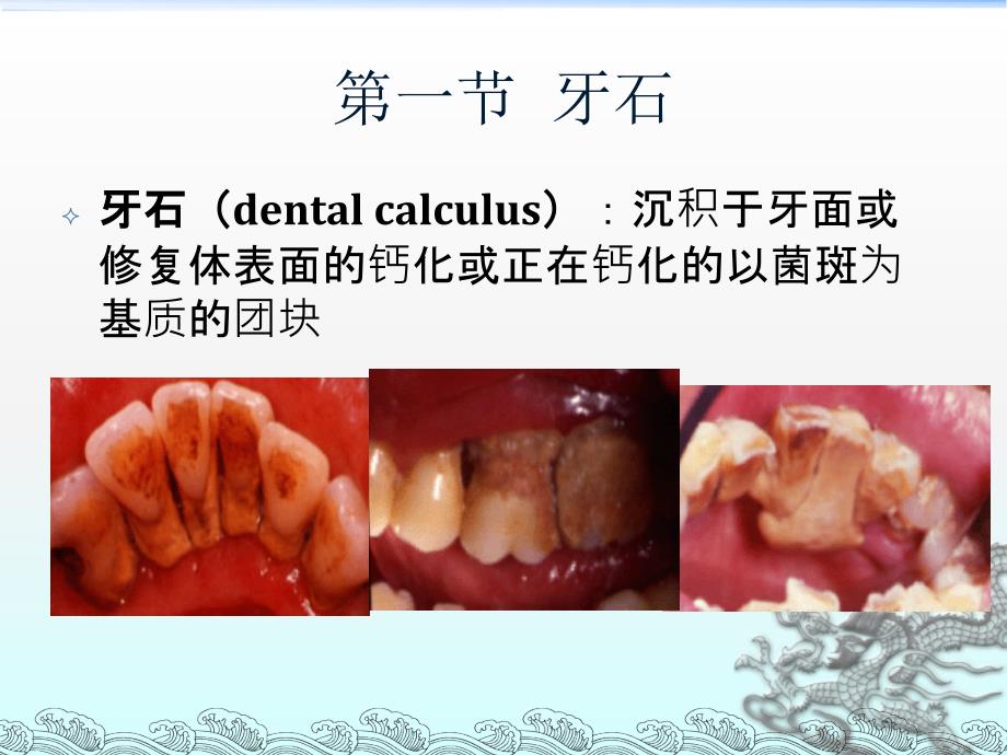 牙周病的局部促进因素ppt课件_第2页