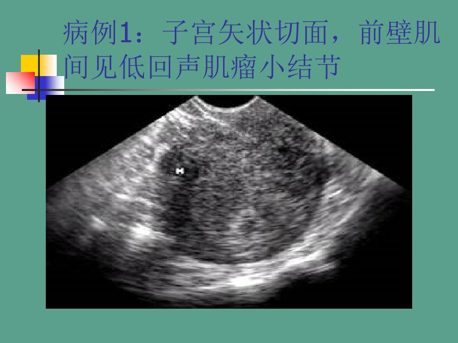 妇科超声诊断病例及片ppt课件_第2页