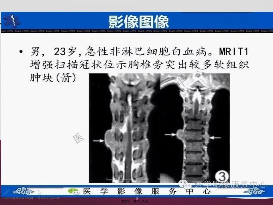 浅谈白血病骨质改变课件_第5页