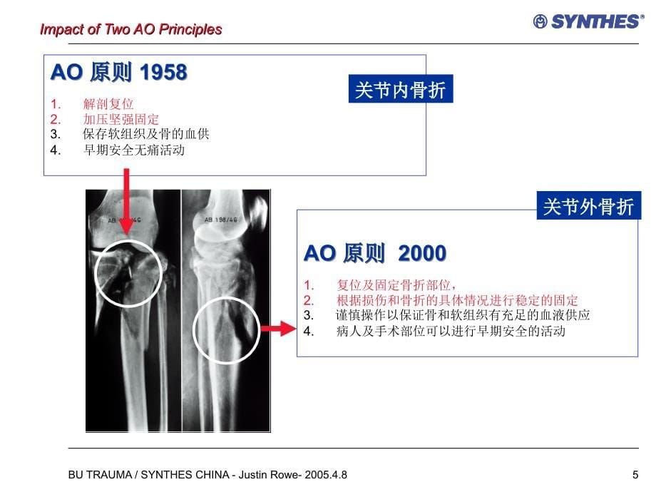 锁定内固定系统临床应用常见问题LCPQuestions_第5页