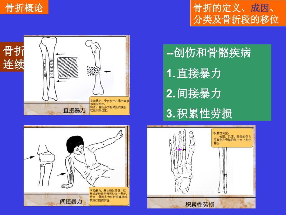 第四十九---骨折概论课件_第4页