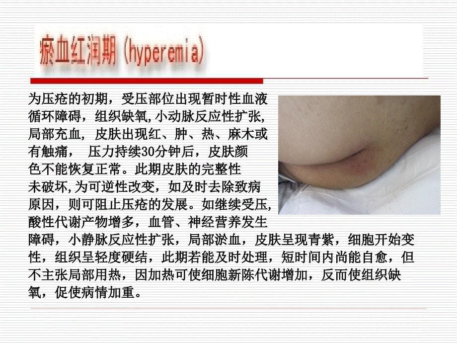 骨科压疮病人的护理.ppt_第5页