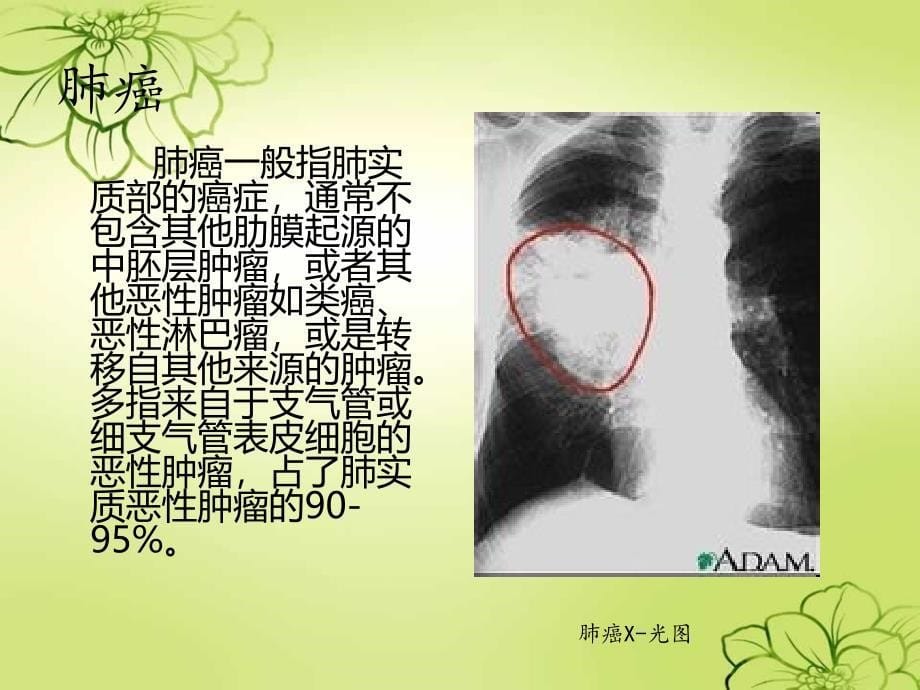 肺癌的护理查房_第5页