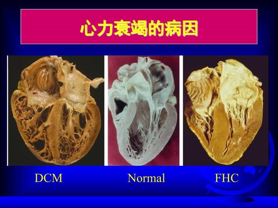 《心力衰竭大》PPT课件.ppt_第5页