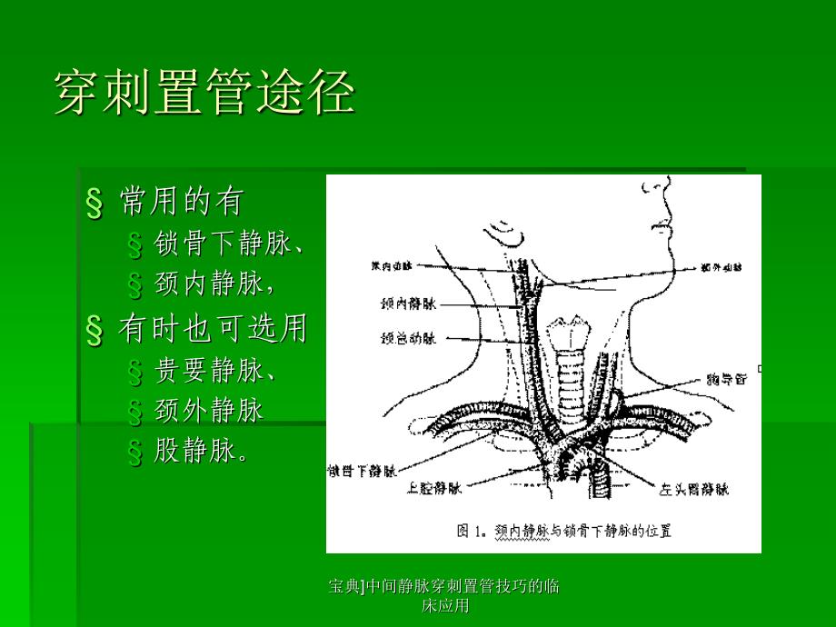 宝典中间静脉穿刺置管技巧的临床应用课件_第3页