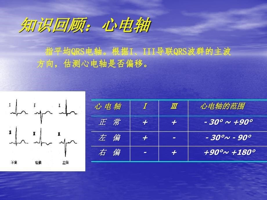 常见心脏疾病心电图诊断.ppt_第5页