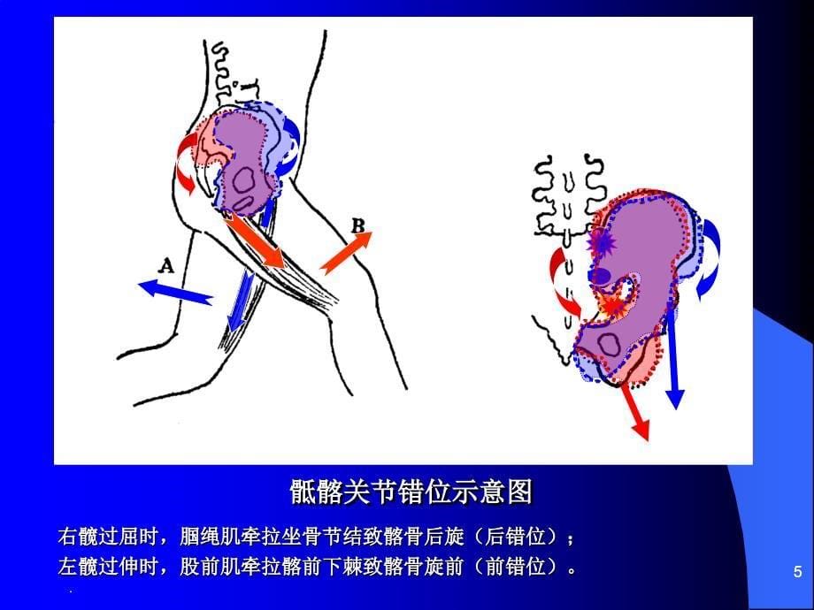 骶髂关节损伤与脱位ppt课件_第5页