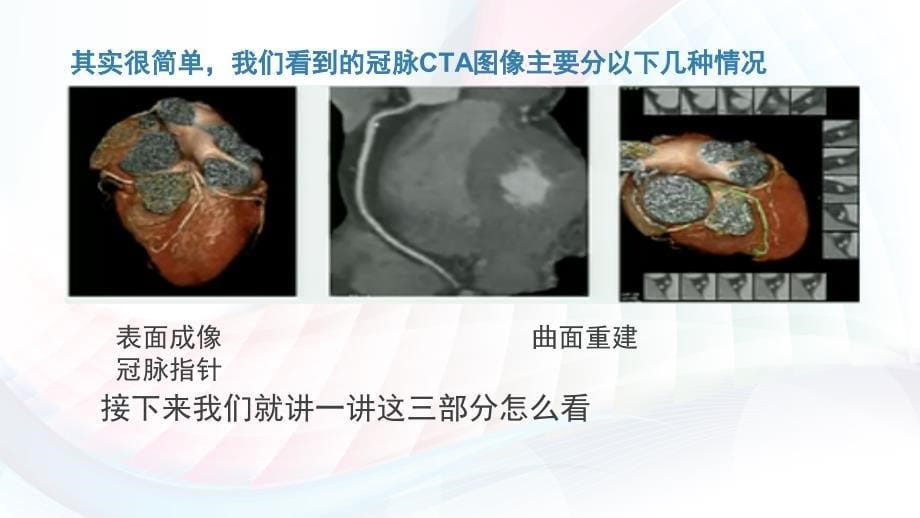 冠脉CTA读片基础教程_第5页