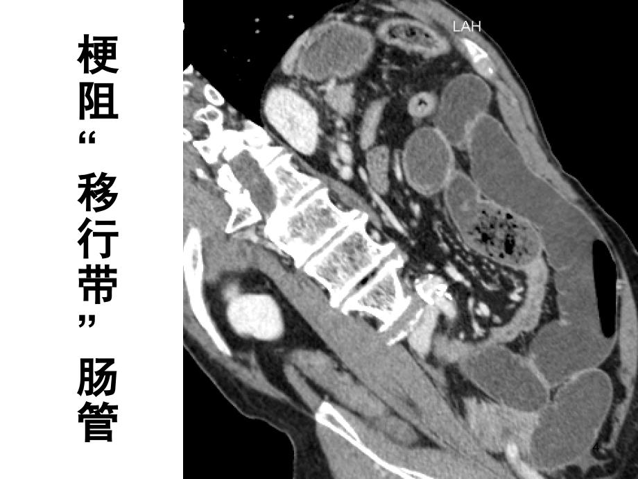 肠梗阻的CT征象PPT参考幻灯片_第4页