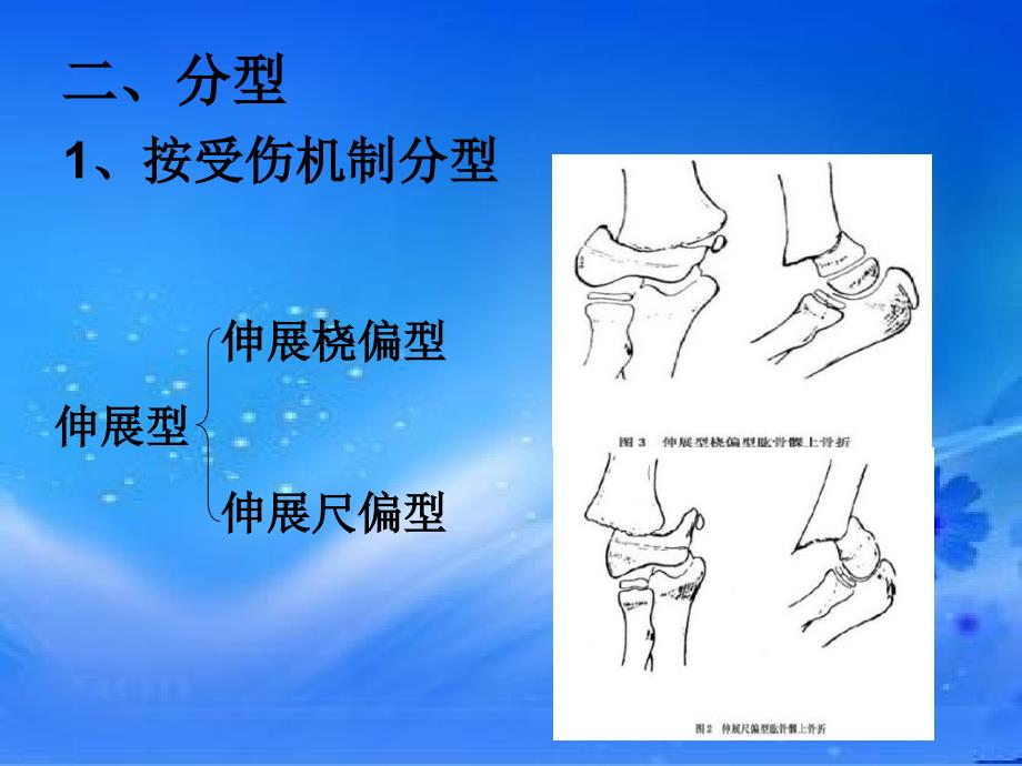 肱骨髁上骨折.ppt_第3页