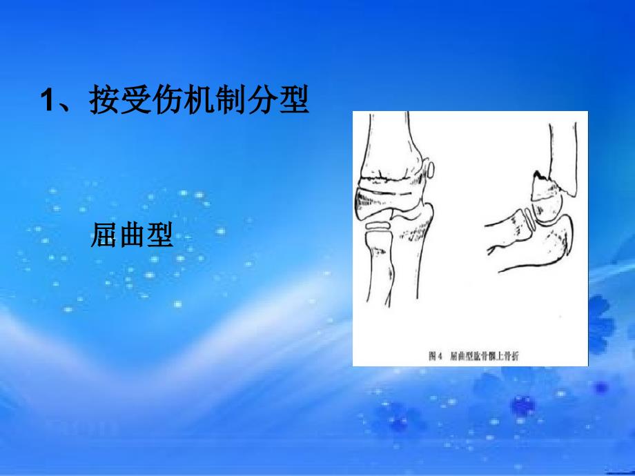 肱骨髁上骨折.ppt_第4页