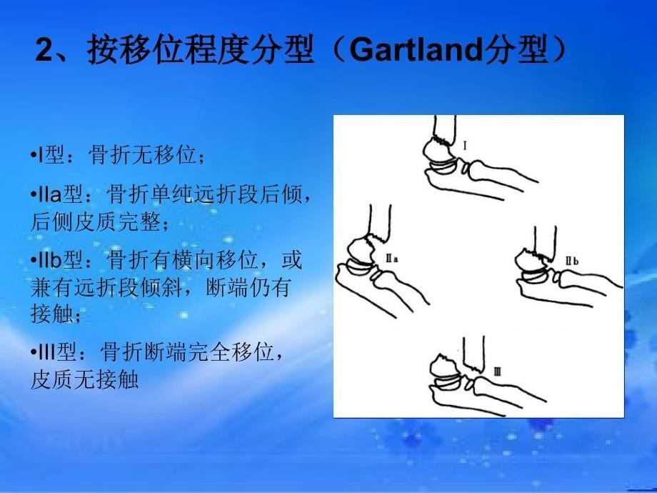 肱骨髁上骨折.ppt_第5页