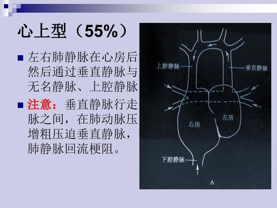 完全性肺静脉异位引流_第5页