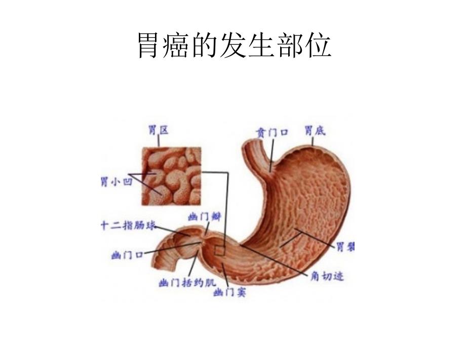 胃癌常见手术方式及术后并发症_第3页