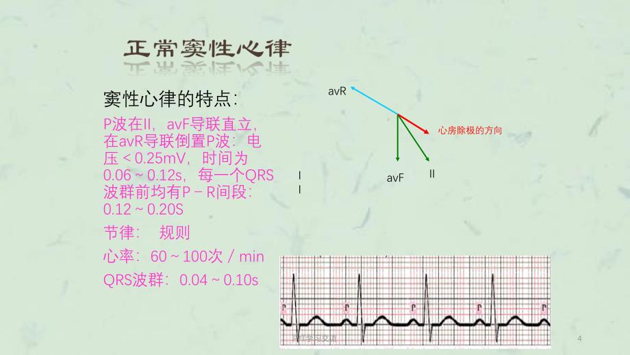 恶性心律失常的识别与护理ppt课件_第4页