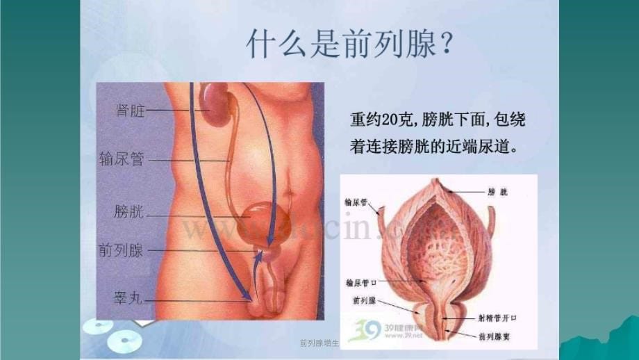 前列腺增生课件_第5页