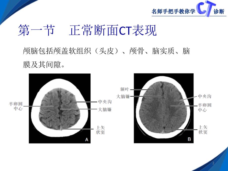 名师手把手教你学CT诊断颅脑ppt课件_第2页