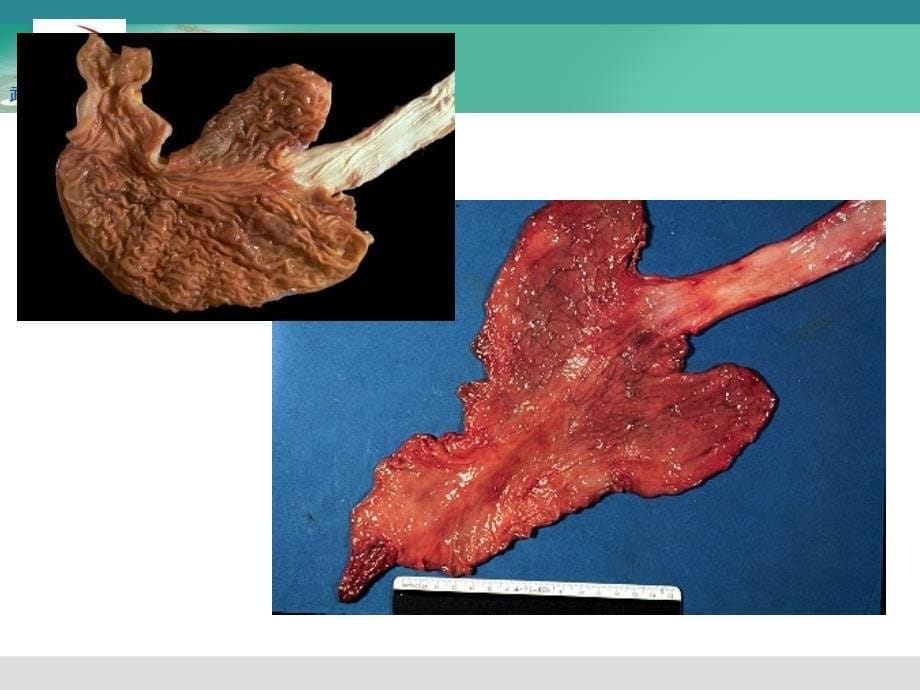 慢性萎缩性胃炎pp课件_第5页
