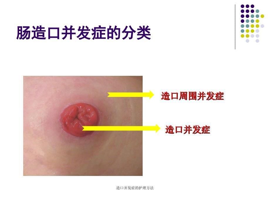 造口并发症的护理方法课件_第5页