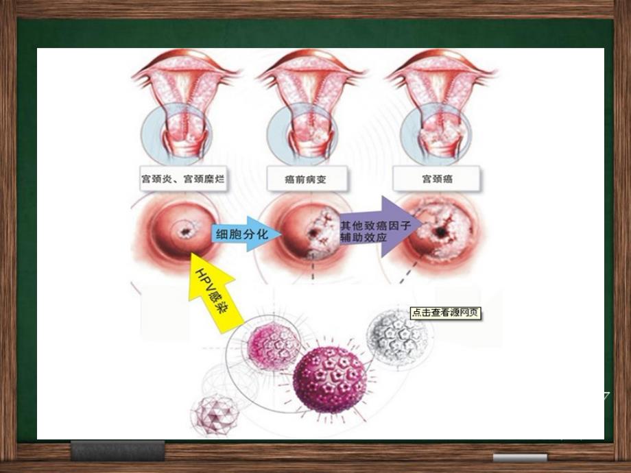 宫颈癌广泛性子宫切除盆腔淋巴结清扫手术配合_第3页