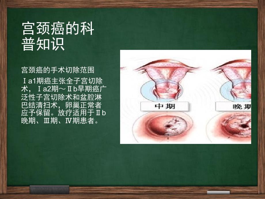 宫颈癌广泛性子宫切除盆腔淋巴结清扫手术配合_第4页